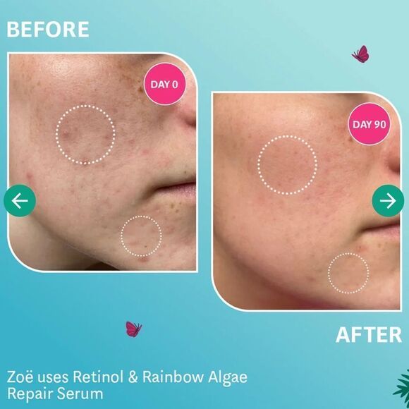 Selfless by Hyram Retinol & Rainbow Algae Repair Serum helps repair acne scars + - Picture 5 of 8